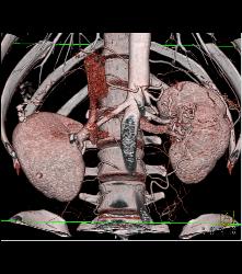 Displaced Hepatic Artery - CTisus CT Scan