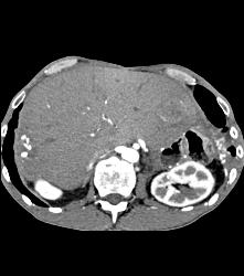 Recurrent Hepatocellular Carcinoma (Hepatoma) - CTisus CT Scan