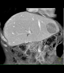 Recurrent Hepatocellular Carcinoma (Hepatoma) - CTisus CT Scan