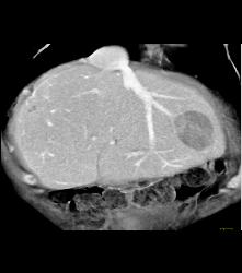 Recurrent Hepatocellular Carcinoma (Hepatoma) - CTisus CT Scan