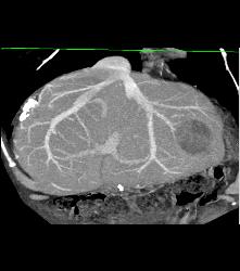 Recurrent Hepatocellular Carcinoma (Hepatoma) - CTisus CT Scan