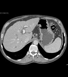 Cirrhosis With Less Than 1 Cm Right Lobe Lesion - CTisus CT Scan