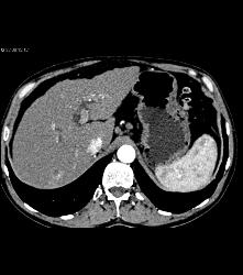 Cirrhosis With Less Than 1 Cm Right Lobe Lesion - CTisus CT Scan