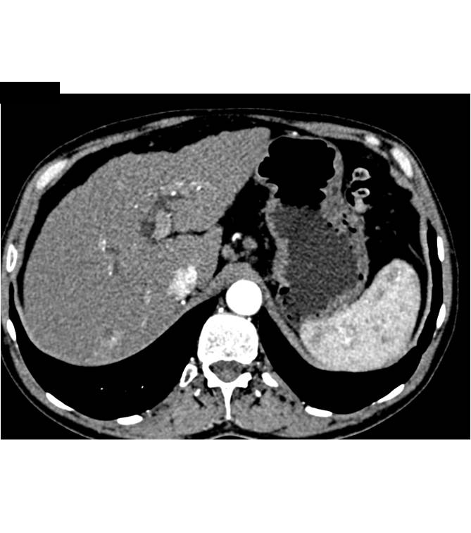 Cirrhosis - CTisus CT Scan