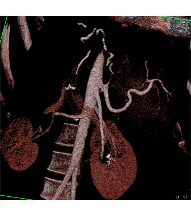 Liver Transplant with Occlusion of Hepatic Artery and Hepatic Infarct/Abscess. Portal Venous Air Also Seen - CTisus CT Scan