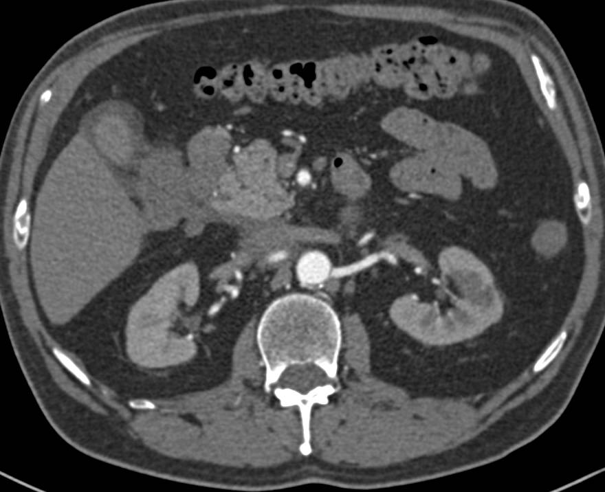 Invasive Gallbladder Cancer with Extensive Adenopathy and Liver Extension - CTisus CT Scan