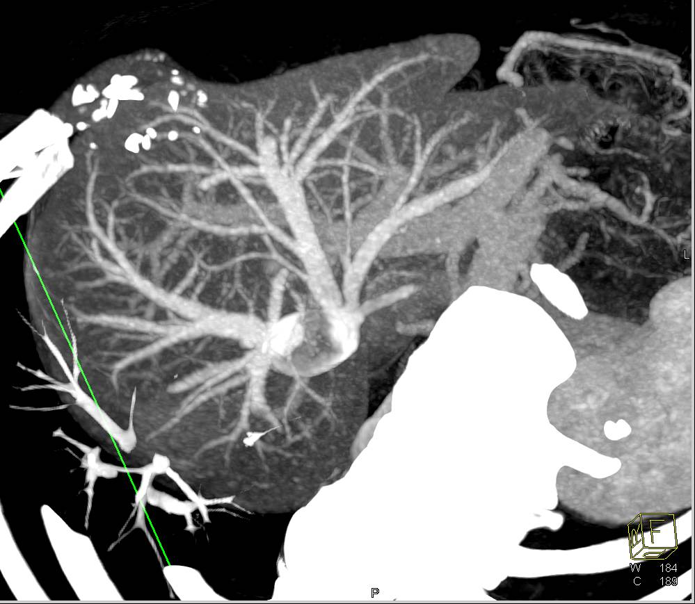 CTA Mapping of Hepatic Venous Anatomy - CTisus CT Scan