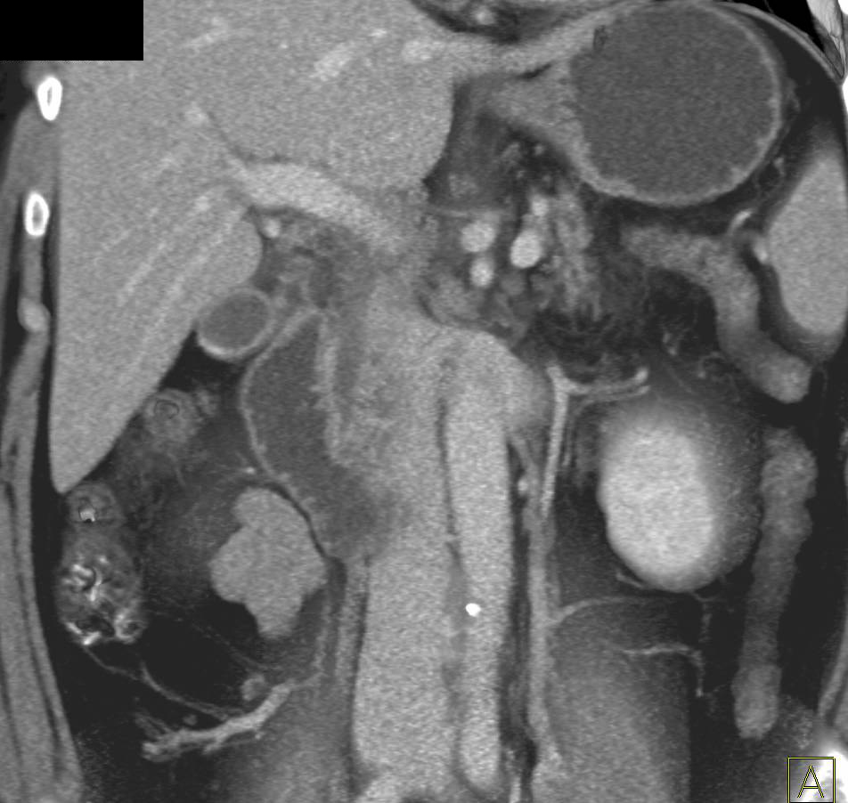 Distal Common Bile Duct Tumor-See Enhancement - CTisus CT Scan