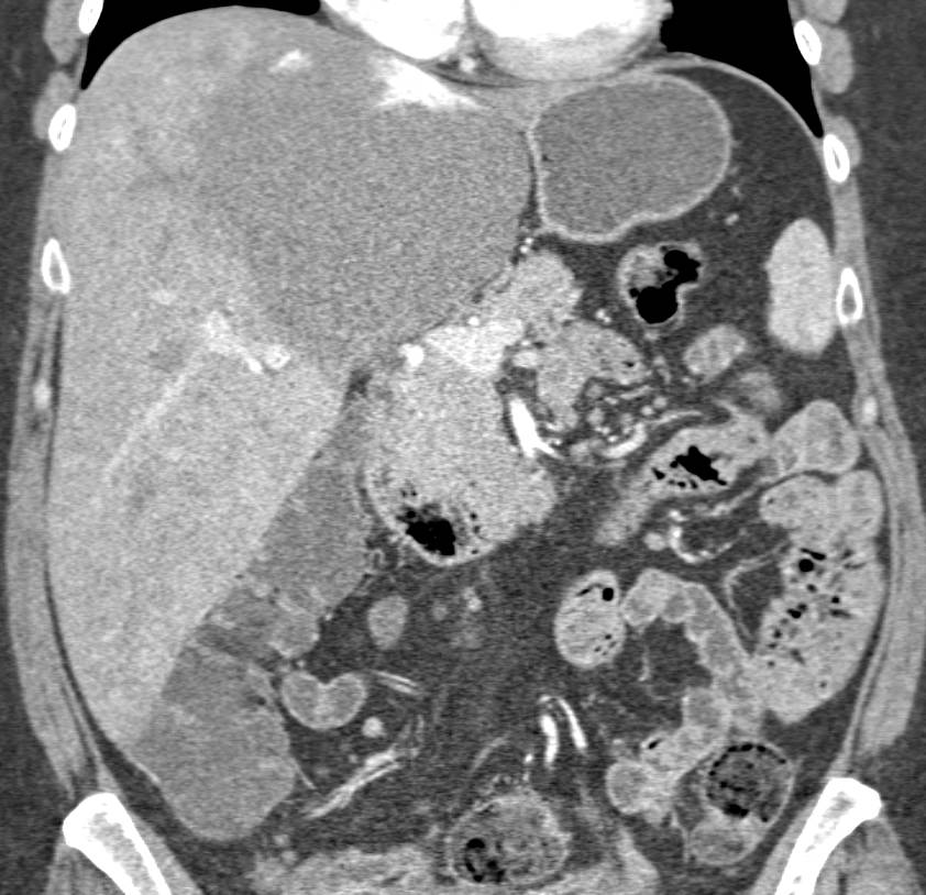 Giant Hepatic Hemangiomas in Multiple Renderings - CTisus CT Scan