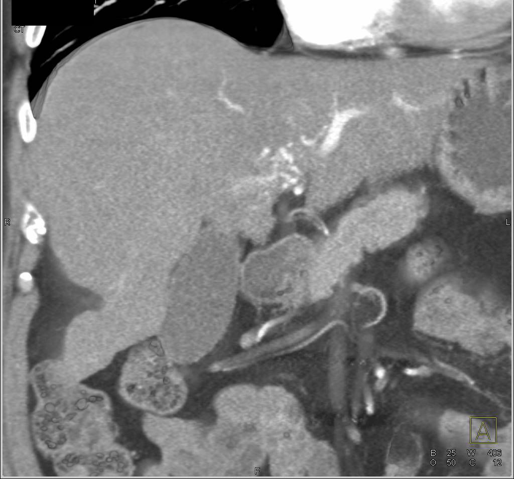 Hepatocellular Carcinoma (Hepatoma) Arising in a Cirrhotic Liver with Arteriovenous (AV) Shunting and Collaterals - CTisus CT Scan