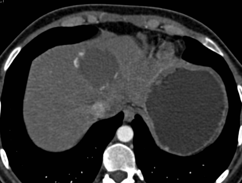 Cavernous Hemangioma of the Liver - CTisus CT Scan