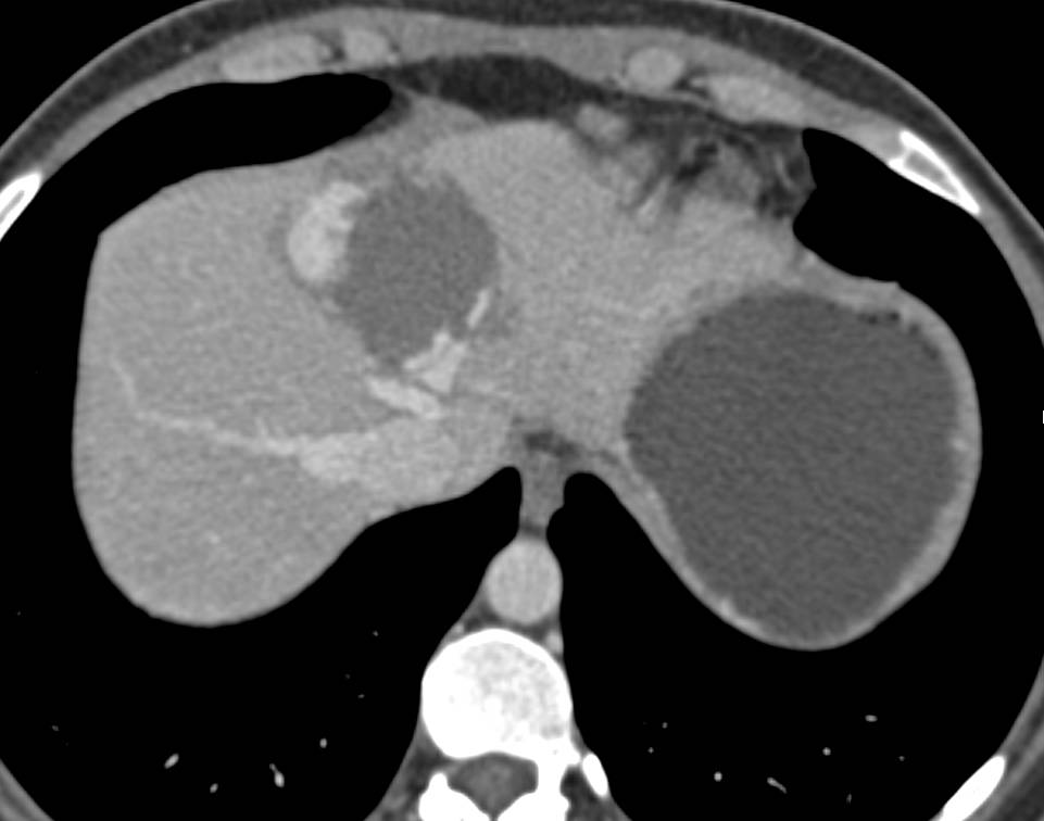 Cavernous Hemangioma of the Liver - Liver Case Studies - CTisus CT Scanning