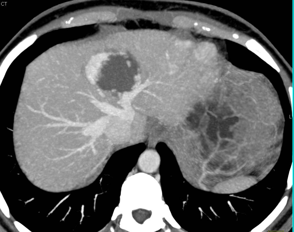 Cavernous Hemangioma of the Liver - Liver Case Studies - CTisus CT Scanning