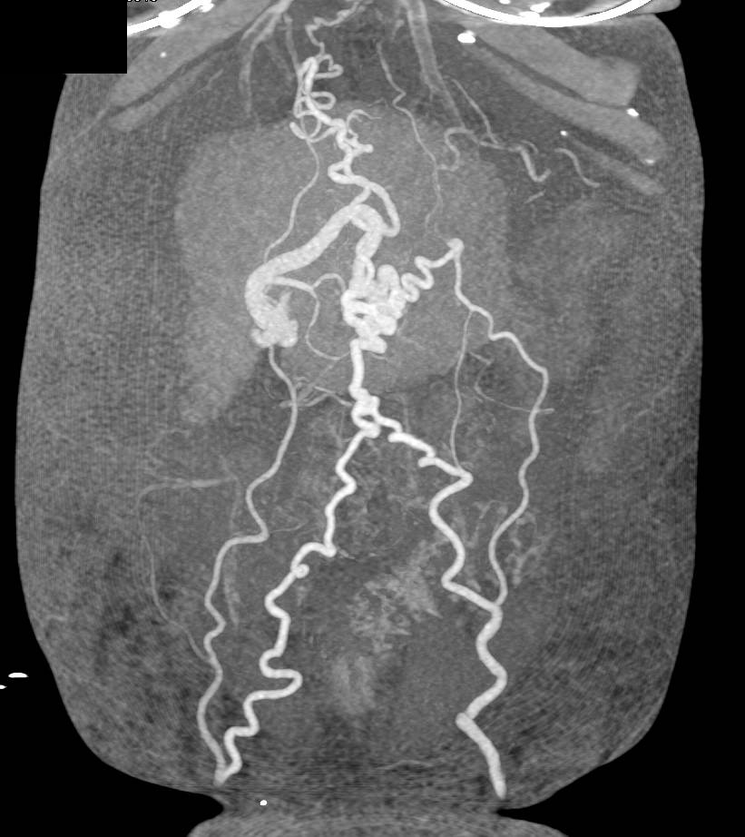 Cirrhosis with Collaterals in the Abdominal Wall with Recanalized Umbilical Vein - CTisus CT Scan