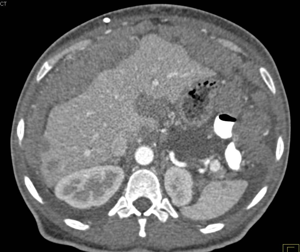 Carcinomatosis with Implants on the Liver and Spleen - CTisus CT Scan