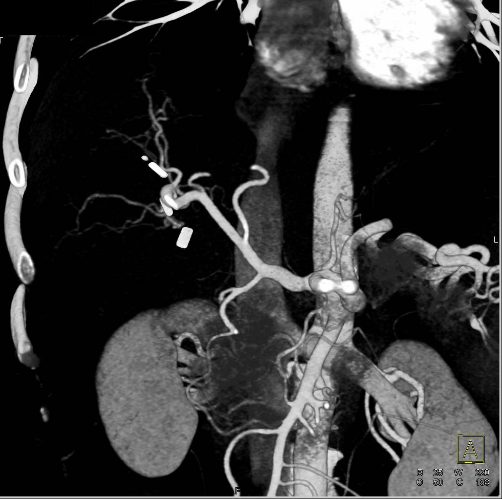 Normal 3D Visualization of Hepatic Artery - CTisus CT Scan