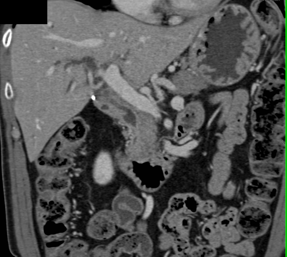 Cystic Outpouching of the Common Bile Duct - CTisus CT Scan