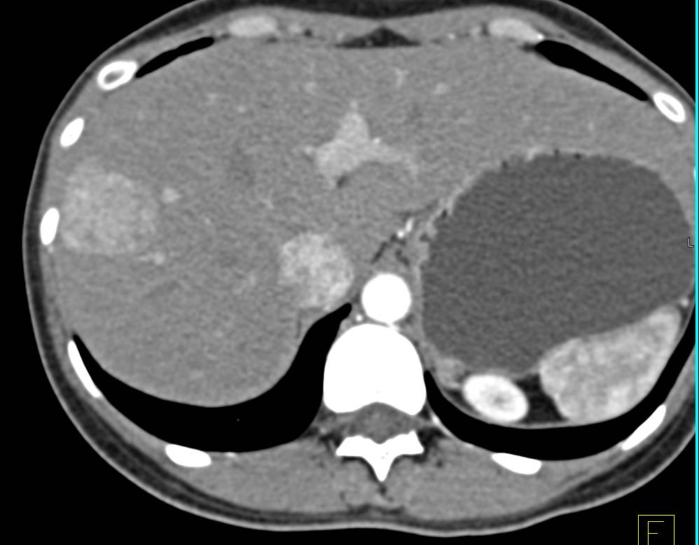 Focal Nodular Hyperplasia - CTisus CT Scan