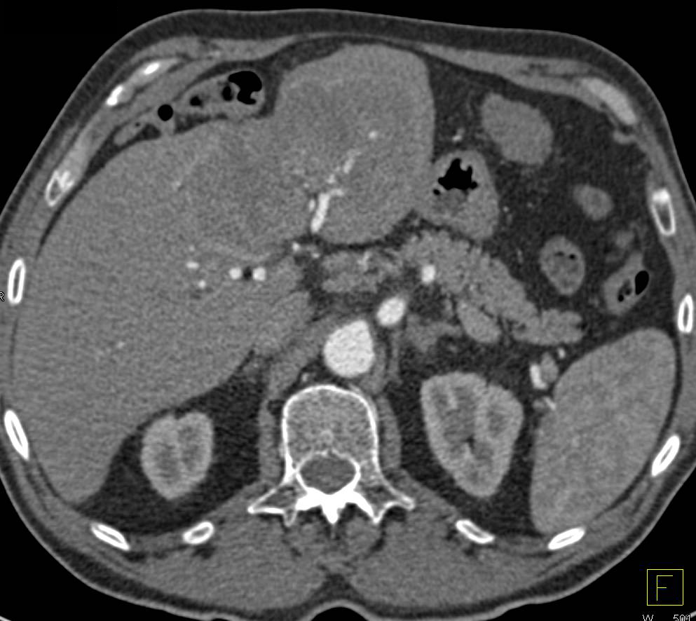 Intrahepatic Cholangiocarcinoma - CTisus CT Scan