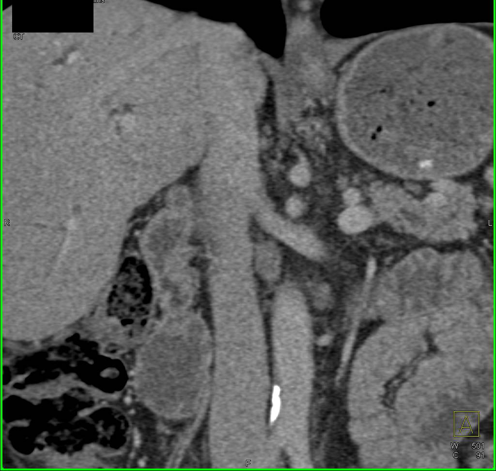 Ampullary Tumor with Dilated Common Bile Duct - CTisus CT Scan