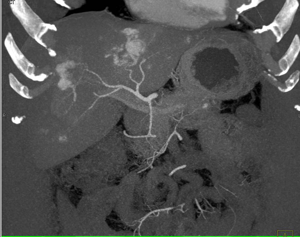 Multiple Hepatic Hemangiomas - CTisus CT Scan