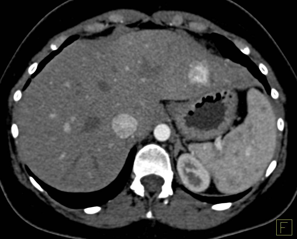 Focal Nodular Hyperplasia - CTisus CT Scan