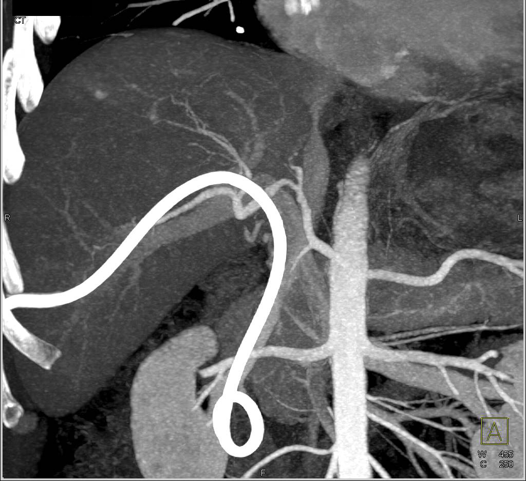 Cholangiocarcinoma with Atrophy of the Left Lobe of the Liver - CTisus CT Scan