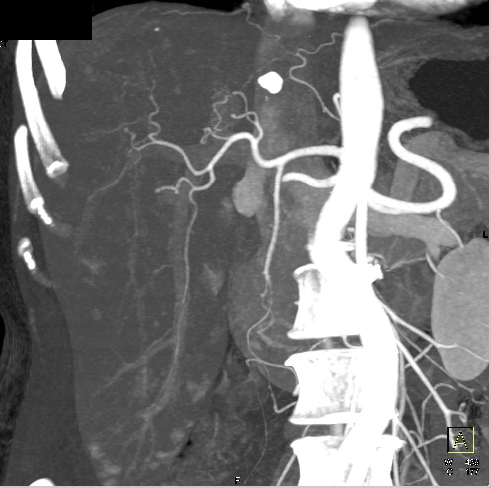 Metastatic Carcinoid Tumor to Liver Seen With MIP Imaging - CTisus CT Scan