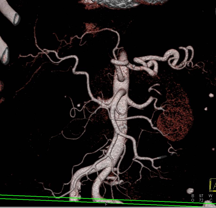 Vascular Map of the Liver with Replaced Right Hepatic Artery off Superior Mesenteric Artery (SMA) as well as nice Venous Anatomy - CTisus CT Scan