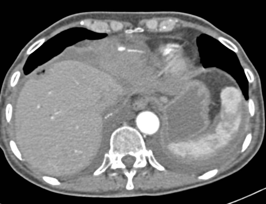 Active Bleed from vessel in Left Lobe of the Liver - CTisus CT Scan