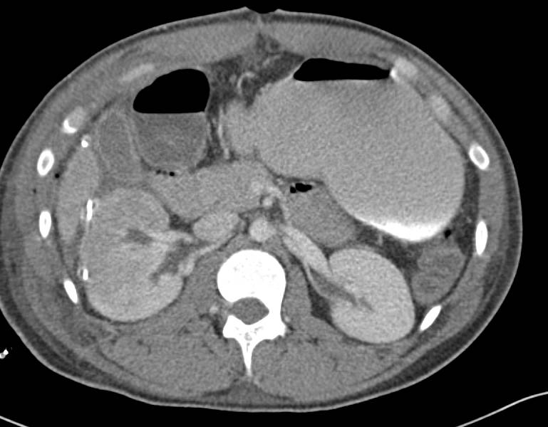 Liver and Renal Trauma - CTisus CT Scan
