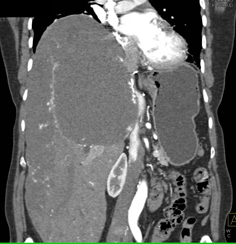 Giant Cavernous Hemangioma of the Liver - CTisus CT Scan