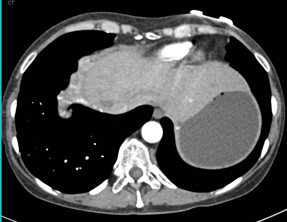 Metastatic Carcinoid Tumor to the Liver with Vascular Metastases - CTisus CT Scan