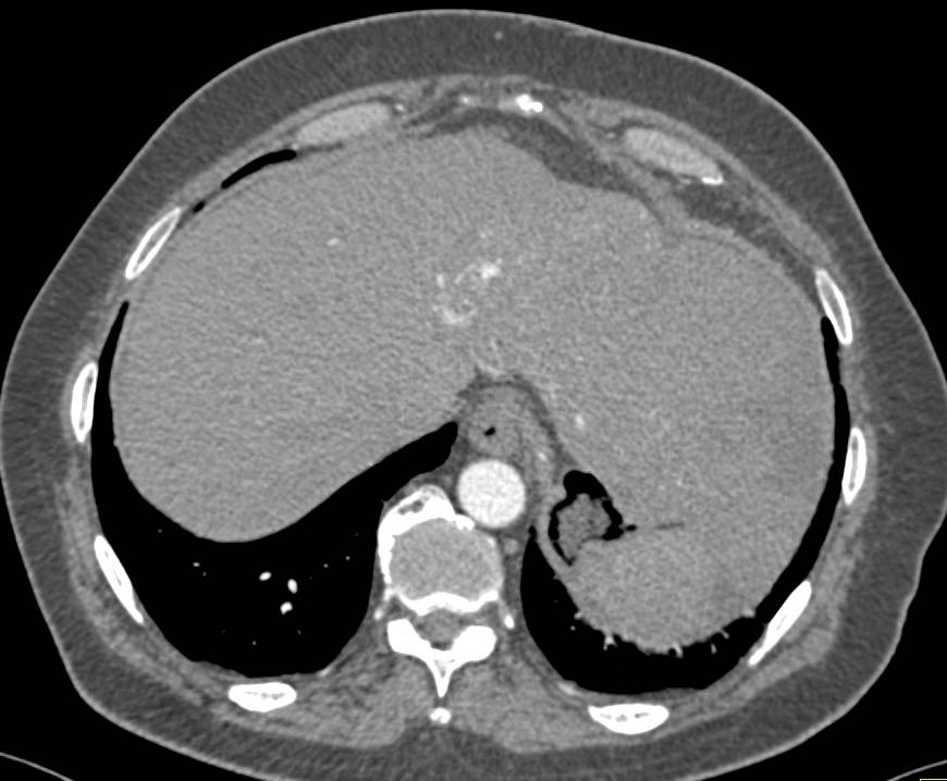 Arteriovenous (AV) Shunting in a Cirrhotic Liver - CTisus CT Scan