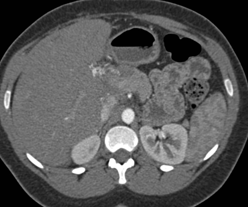 Cholangiocarcinoma with Encased Hepatic Artery and Arteriovenous (AV) Shunting - CTisus CT Scan