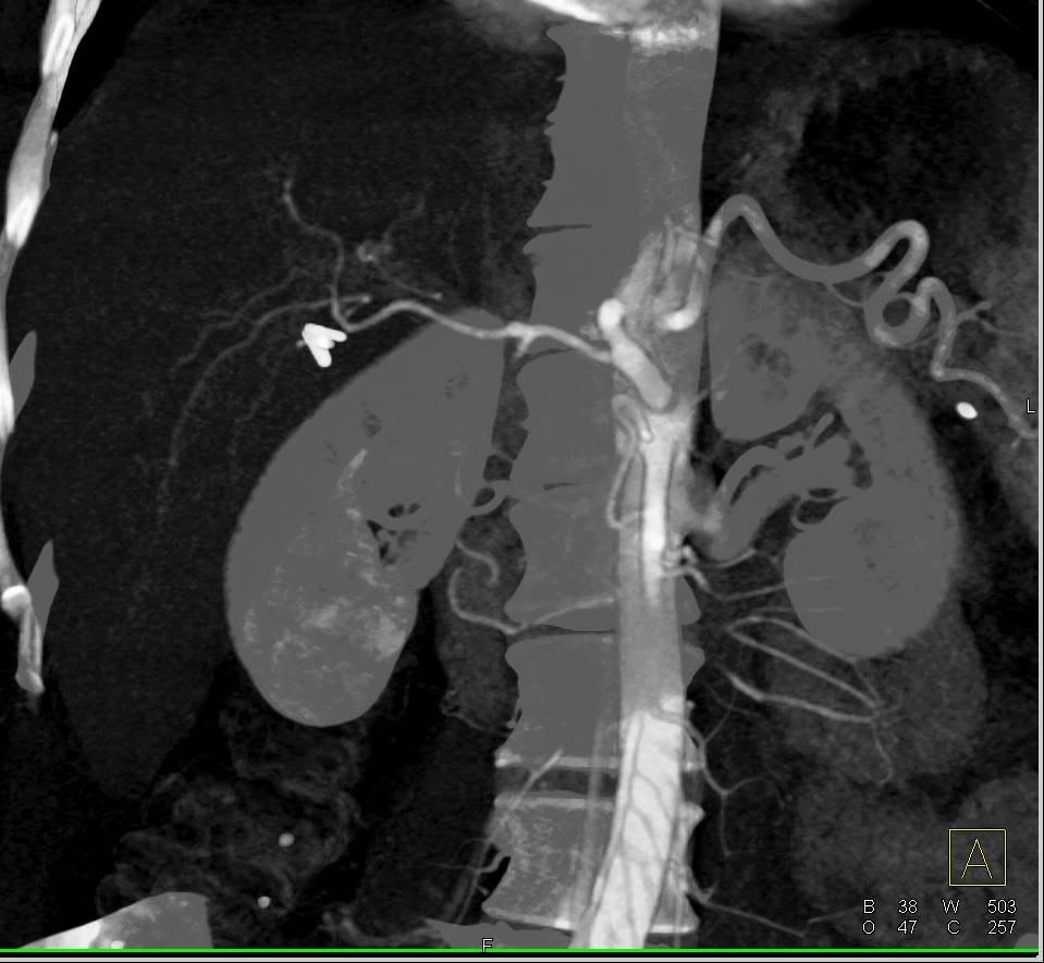 Hepatic Hemangioma - CTisus CT Scan