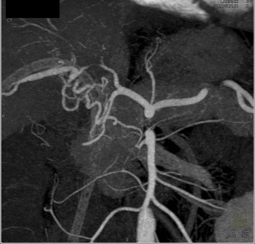 CTA with Cholangiocarcinoma Encasing Hepatic Artery - CTisus CT Scan