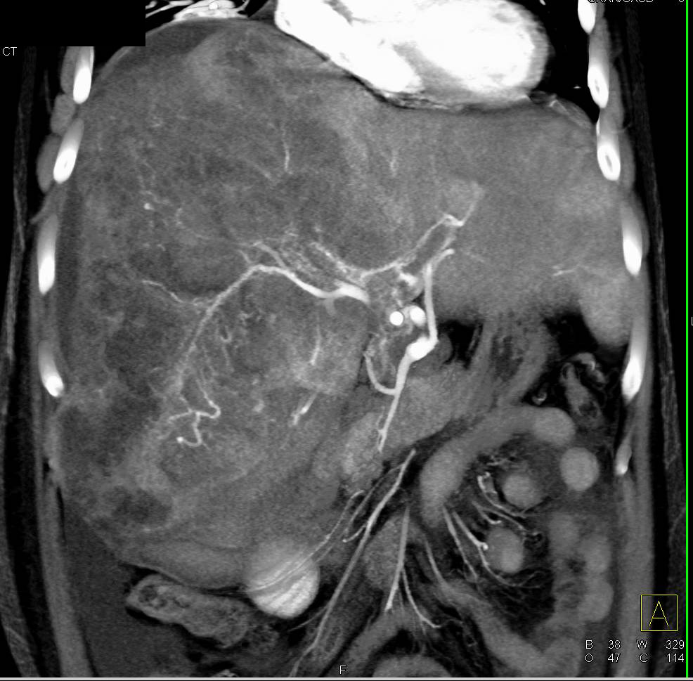 CTA Hepatocellular Carcinoma (Hepatoma) with Neovascularity - CTisus CT Scan