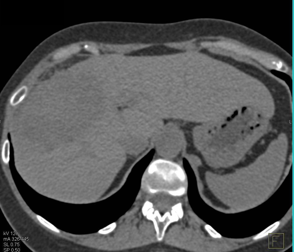 Multifocal Hepatocellular Carcinoma (Hepatoma) with Unusual Enhancement Pattern. Portal Vein (PV) is involved. - CTisus CT Scan