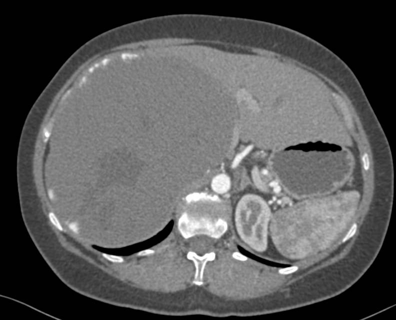 Giant Cavernous Hemangioma of the Liver in Multiple Phases and Displays - CTisus CT Scan