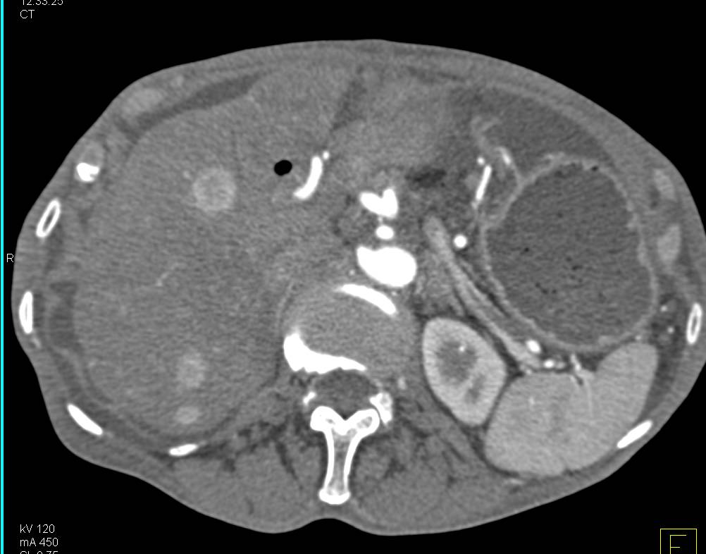 Metastatic Carcinoid to the Liver - CTisus CT Scan