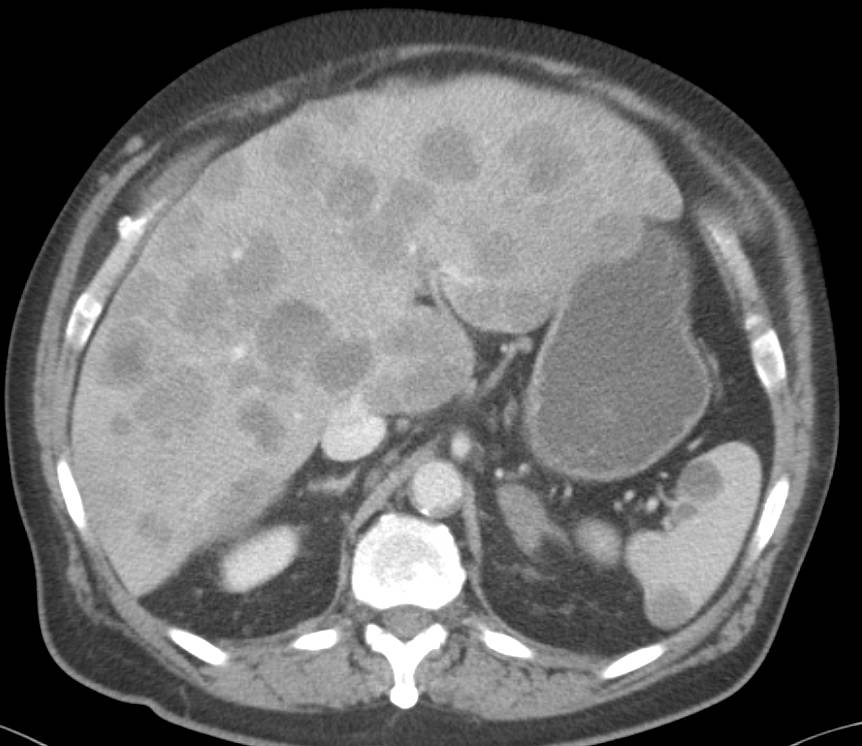 Metastatic Melanoma to the Liver and Spleen - CTisus CT Scan