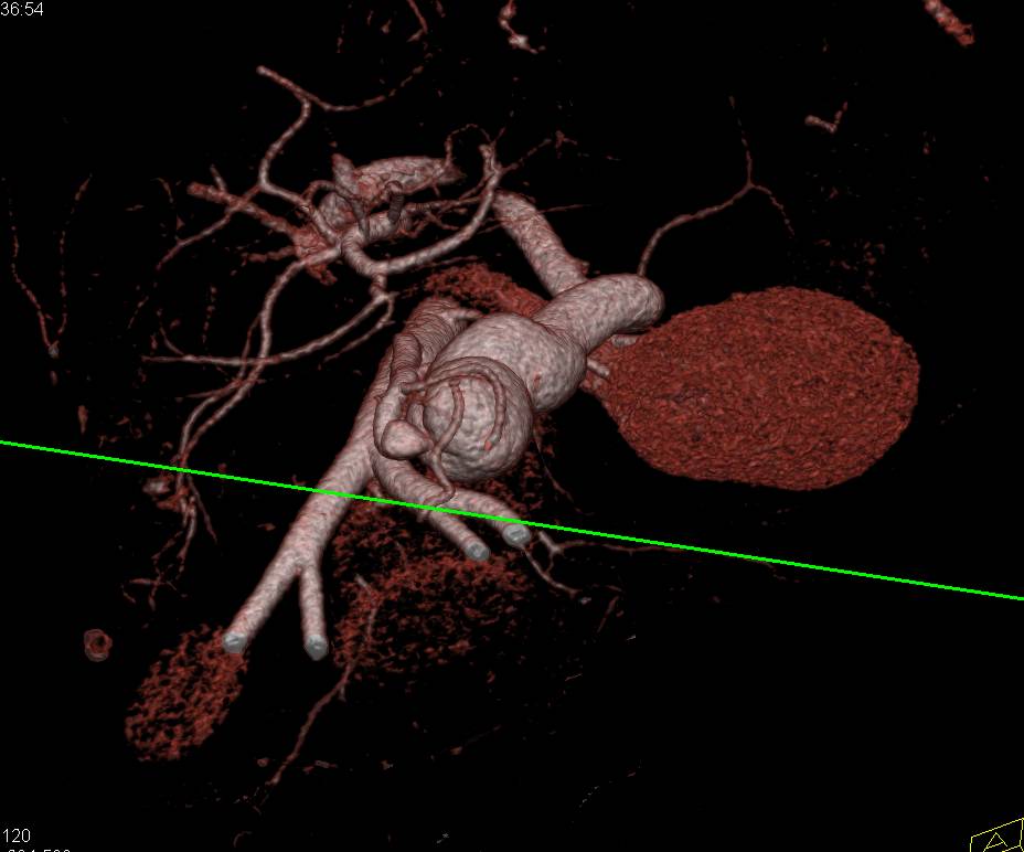 Portal Hypertension with Incredible IMV Aneurysm - CTisus CT Scan