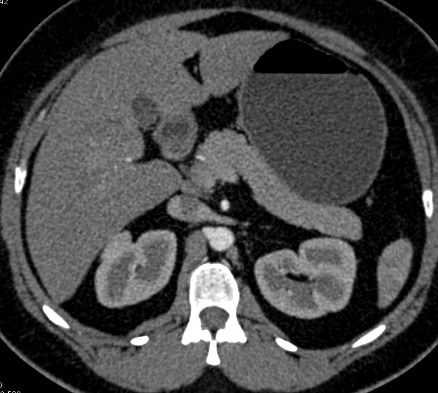 Vascular Liver Metastases - CTisus CT Scan