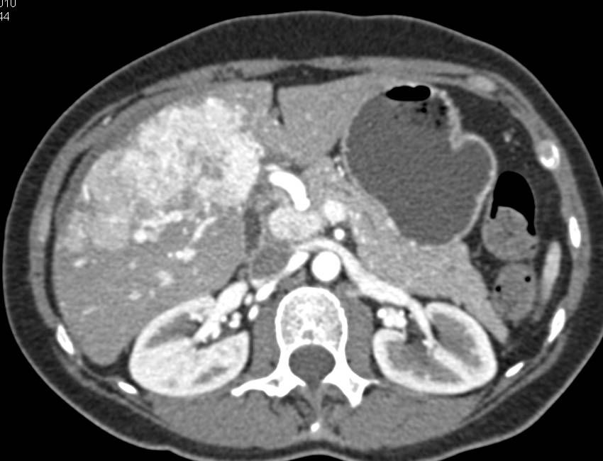 Metastatic Neuroendocrine Tumor in the Liver - CTisus CT Scan