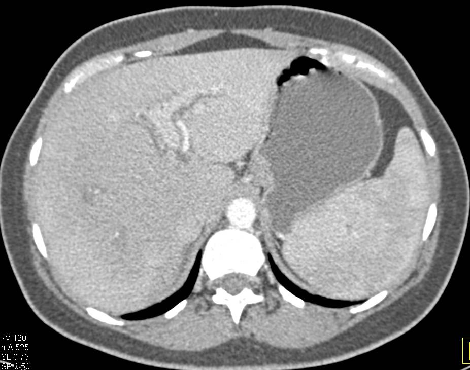 Distal Common Bile Duct Tumor with Adenopathy and Cavernous Transformation of the Portal Vein - CTisus CT Scan