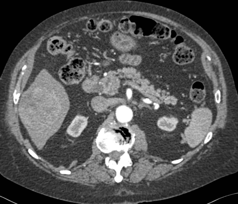 Hepatocellular Carcinoma (Hepatoma) in Multiple Phases - CTisus CT Scan