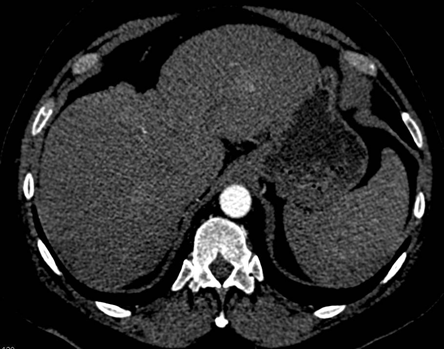 Hepatic Arterial Mapping - CTisus CT Scan