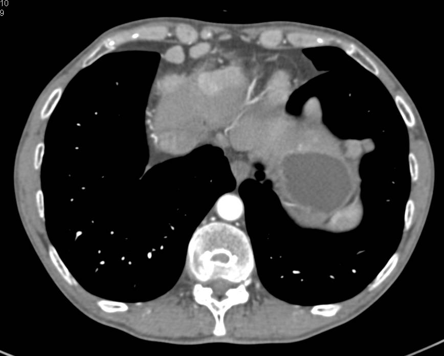 Carcinoid Tumor with Implants on Diaphragm, Liver and Paracardiac Nodes - CTisus CT Scan