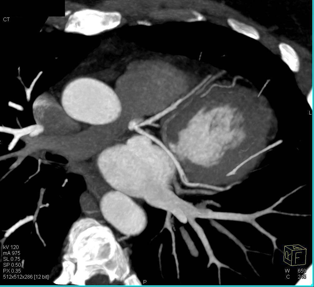 Incidental Giant Hepatic Hemangioma in Patient Who Also had a Coronary Artery Study - CTisus CT Scan